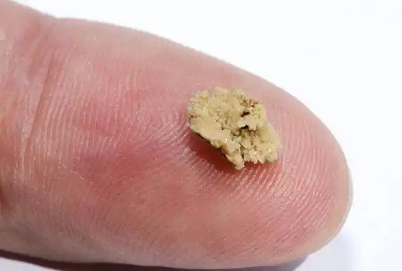 2-4mm,将近8成可能自己排; 5-7mm的结石大概6成; 7~9mm有5成可能