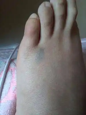 脚又无端端青了