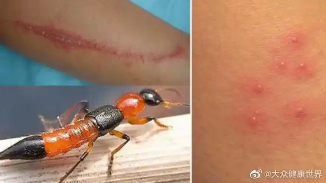 隐翅虫##遇隐翅虫切勿直接拍打