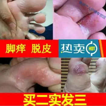 脚趾缝溃烂苗家五毒散治水泡脱皮止i痒膏脚趾间烂汗脚祛臭脚痒绅器