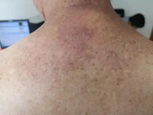 今天一个姑娘来看皮肤,说是去年夏天开始出现的,因为长在后背,不容易