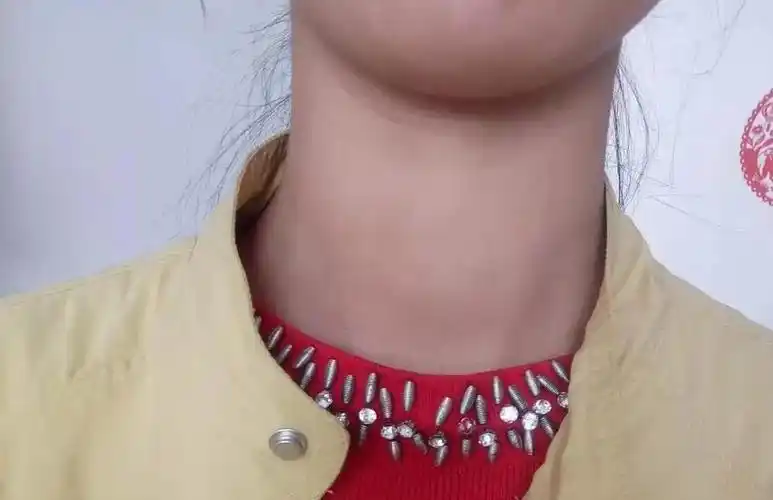 26岁女教师查出甲状腺结节,和一个原因有关,很多女人都会中招!