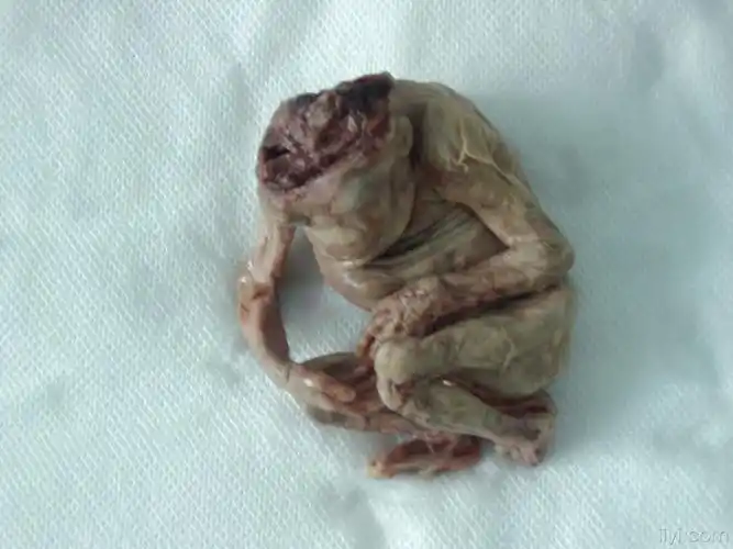 无脑儿伴脊柱裂有标本