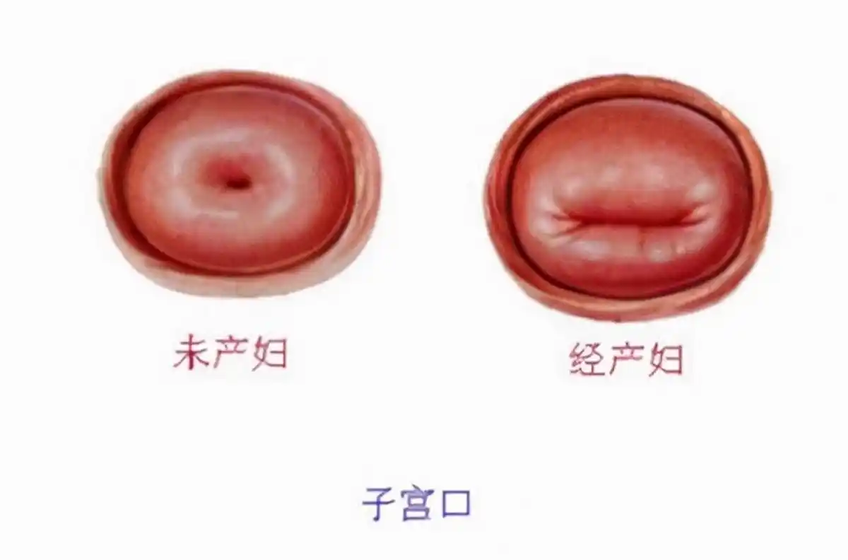 而有堕胎史的女性,宫颈口会有些外翻,这是受到医疗器械影响的缘故