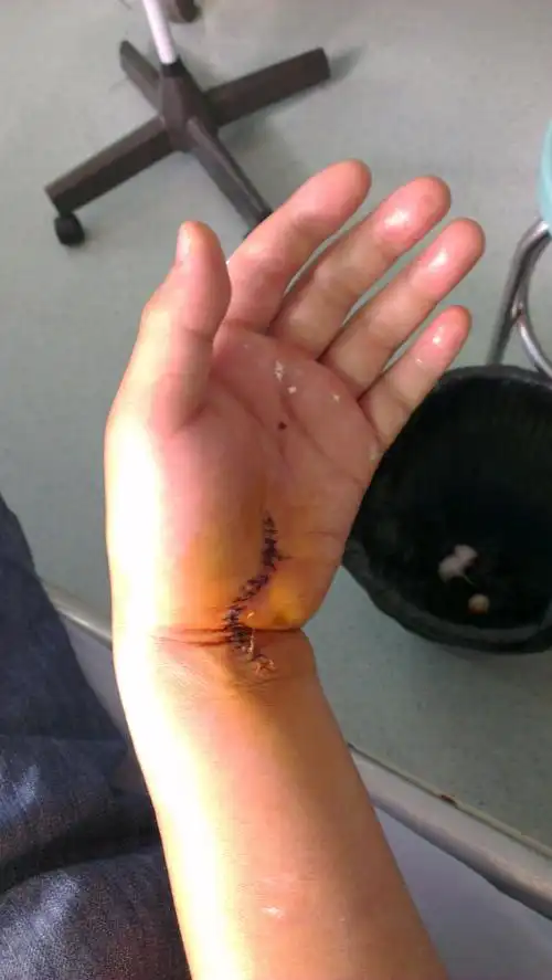 左手月骨脱位手术后打了石膏15天后,手腕开刀的伤口位置轻微疼痛和