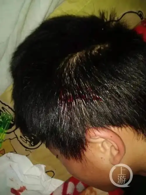 湖南一初中生偷家中300元谎称遭同学抢劫,家长将对方殴打致颅骨骨折