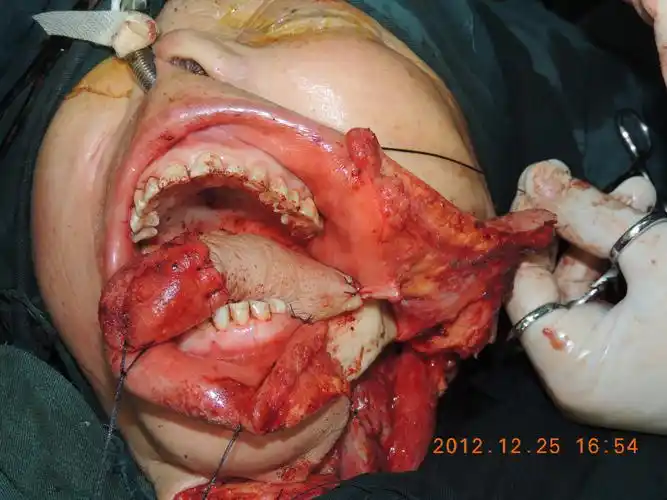 舌癌扩大切除 前臂皮瓣修复(游离皮瓣修复)