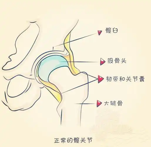 髋关节发育不良的治疗方法