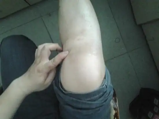 骨质增生对症治疗包括以下几个方面:动静结合,防止过劳,防寒保暧,同时