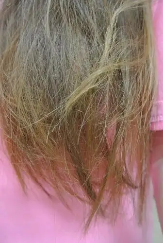 头发掉得很多!洗头 梳头都是一把一把的掉,这是怎么回事?