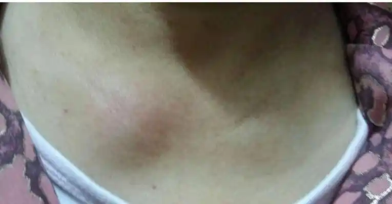 【骨关节炎】少见的骨关节炎:胸锁关节炎