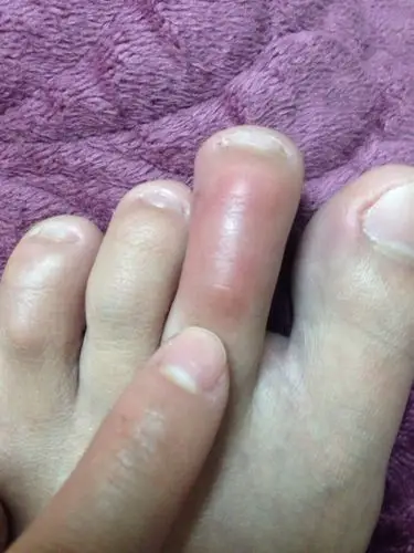 医生,你好!我想咨询一下,我的脚趾头有肿