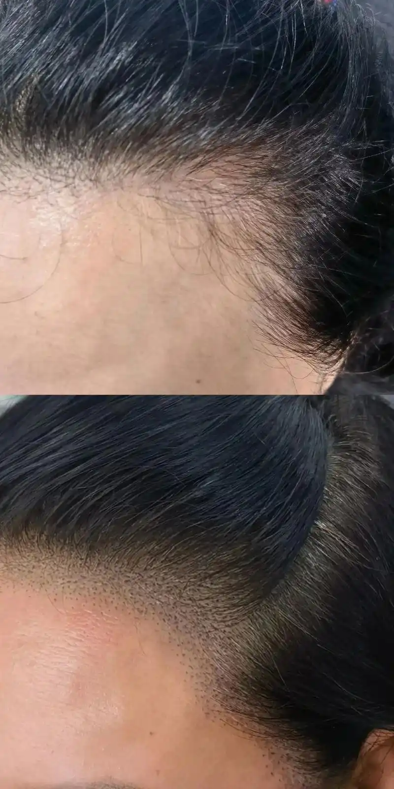 纹鬓角.美女79年的,随着年龄的增长也会有白发和脱发现象,纹