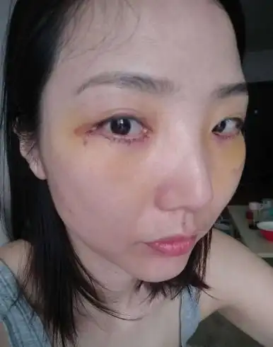 眼袋内切一年后图片,做眼袋手术多久恢复,分享我的经历