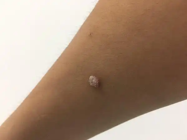 胳膊处长了个瘊子,起初没管,现在越来越大.身体一直没事,怎么会长