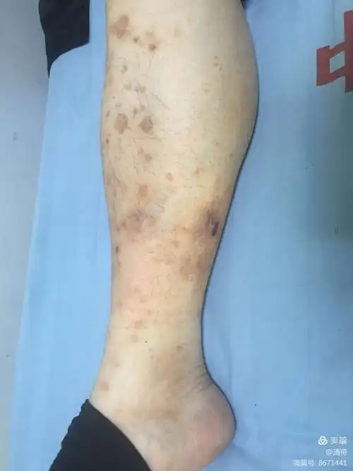 一例糖尿病皮肤病变病例观察