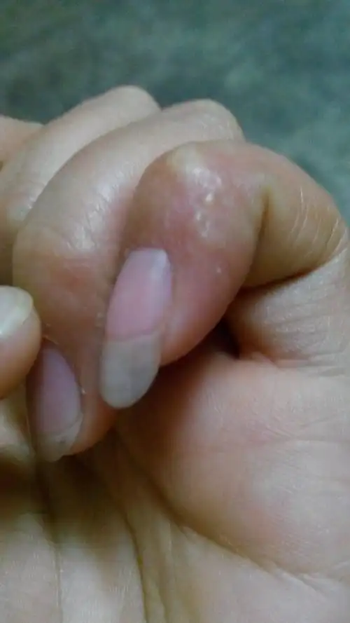 手指上起好多小水泡是怎么了?开始手指痒,抓抓就起小亮泡了