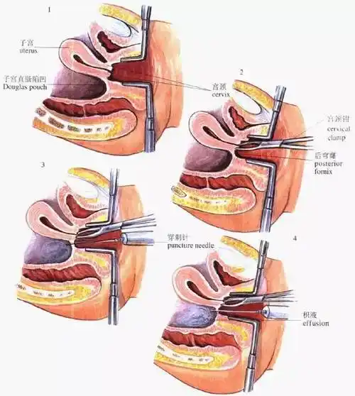 7大常见妇科操作 这些技巧你值得拥有