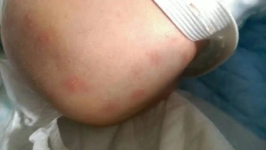 新生婴儿三天屁股红陀陀,是不是天气太热唔成这样的?