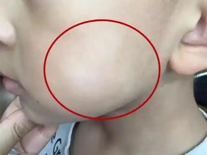 孩子脸上白斑是肚子里有虫缺乏维生素真相是