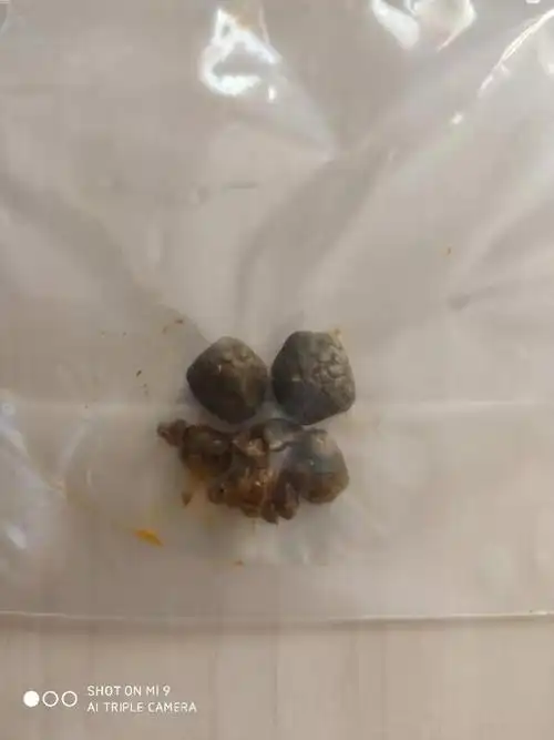 年轻的胆结石患者,除了切胆还有更好的选择——保胆取石,保留有功能的