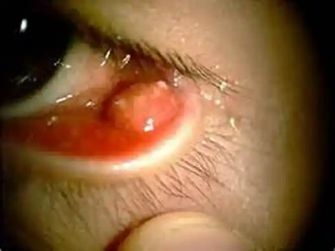 其他麦粒肿医院_其他治疗麦粒肿哪家医院好_其他治疗麦粒肿最好的医院