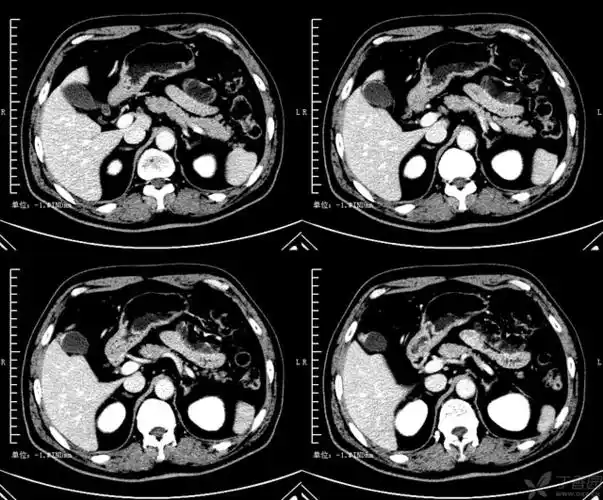 【小讲座】基底型胆囊腺肌症典型影像表现及其鉴别问题