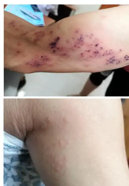 蛇串疮真的会串一圈要人命吗