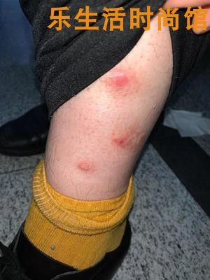 屁股疙瘩痘痘痒牛皮癣买2送1 舒立嘉万毒膏药膏皮肤外用 抑菌止痒