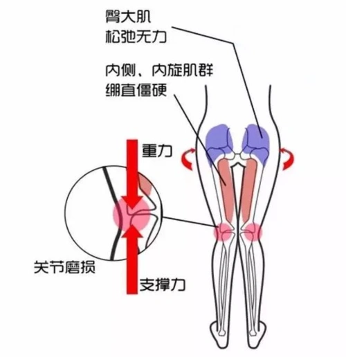 x型腿是多是膝盖内翻,造成原因无外乎股骨内收,内旋和胫骨骨外展,外旋