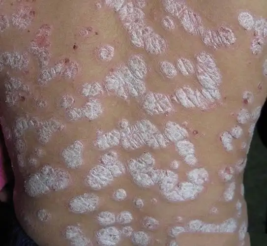 小孩颈部癣的症状图片