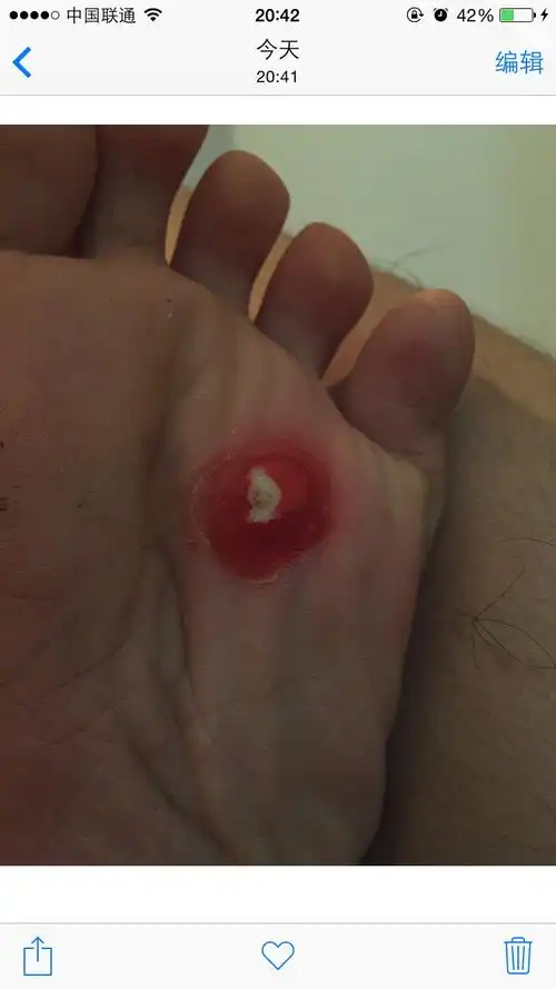 请问是鸡眼吗我贴鸡眼膏半个月了走路还是痛坑里面全是白色