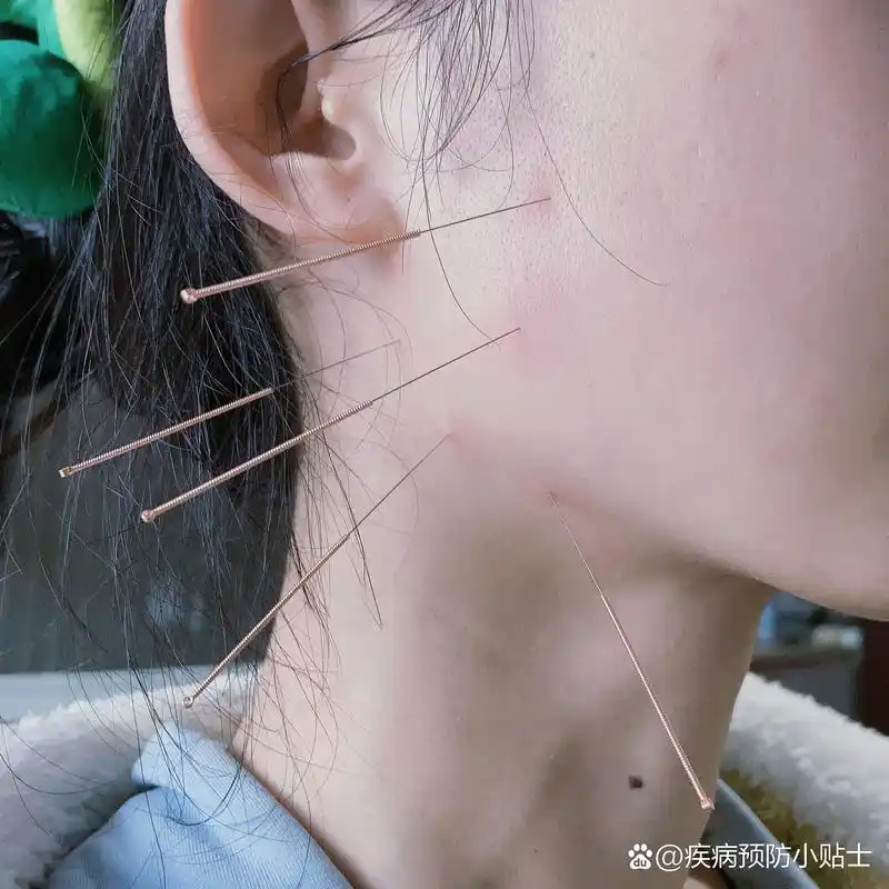 针灸中药配合治疗颞下颌关节紊乱 张口疼痛 此笔记不涉及医疗75仅供