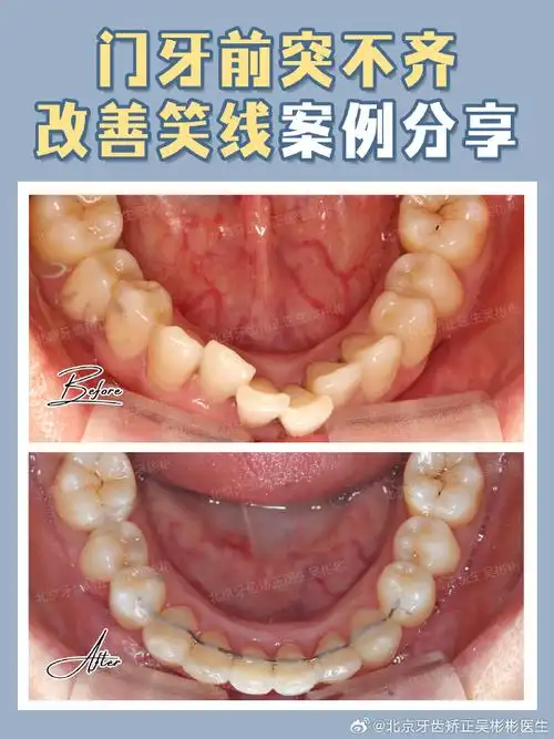 牙齿矫正##吴医森的牙齿矫正案例##整牙