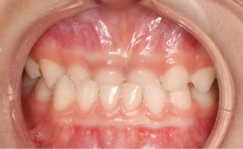 乳牙期地包天以牙性伴功能性为主,矫正方法也比较简单,常用矫治器有