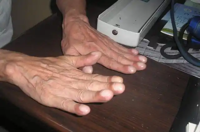 肺癌早期症状居然跟感冒差不多身体出现这9种变化要当心了