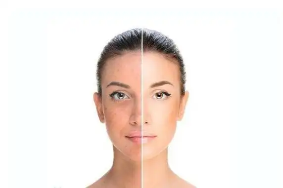 皮肤暗黄吃什么维生素比较好 皮肤暗黄粗糙毛孔大怎么改善