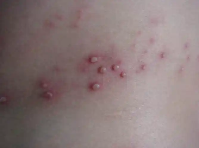 女性股藓症状表现的图片_有来医生