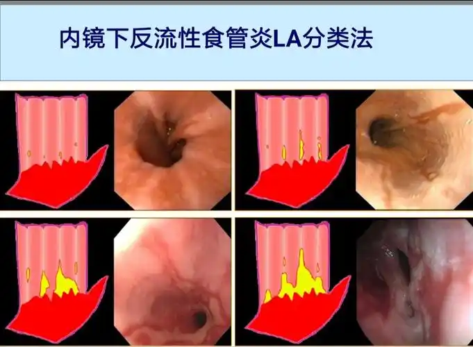 解读胃镜报告——反流性食管炎_反流性食管炎_反流性食管炎检查 - 好