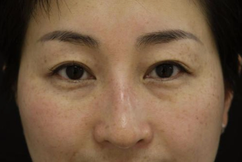 肝郁气滞型黄褐斑,逍遥丸加"一药",疏肝化瘀,斑淡化的更全面