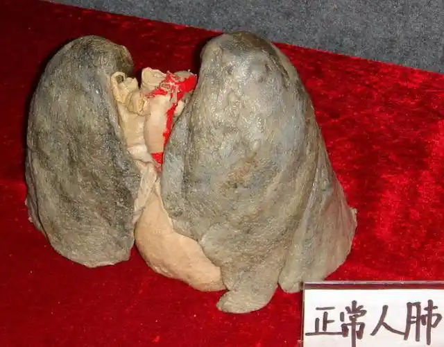 戒烟一年了肺部变化图片30年烟龄的肺会被熏成什么样