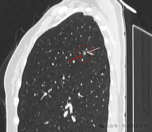 问诊分析:肺混合磨玻璃结节就得尽快手术?其实也可多年不进展的!
