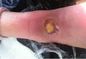 化疗药物外渗,穿刺部位烂成这样怎么办?-腾讯新闻