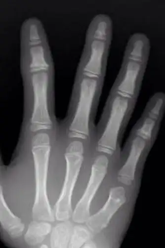 帮我看看我的骨骺线闭合没有啊?