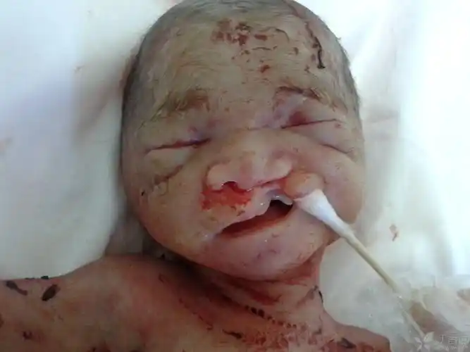 【读片】胎儿唇裂并隐性腭裂,眶间距增宽一例