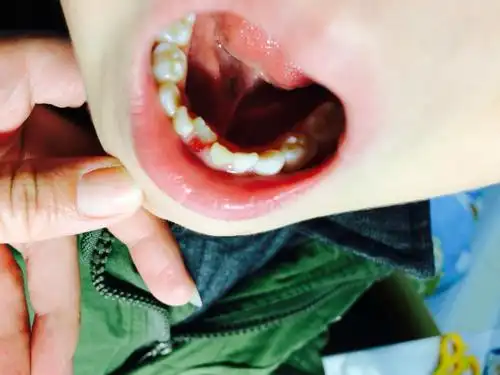 孩子快七岁,下牙掉了一颗,长出来的新牙在后面,附图片,请问这样正常吗