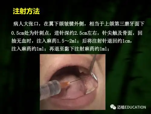 口腔局部麻醉技巧