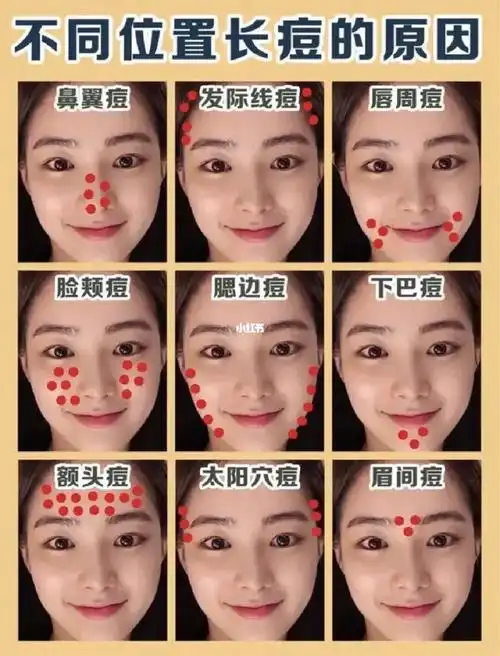 长痘必看75秒懂脸蛋不同位置长痘原因99
