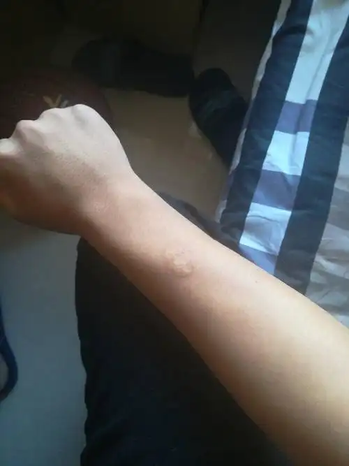 手上有烟疤还能当兵吗 遮挡后能当兵吗 能的话请问怎么遮挡