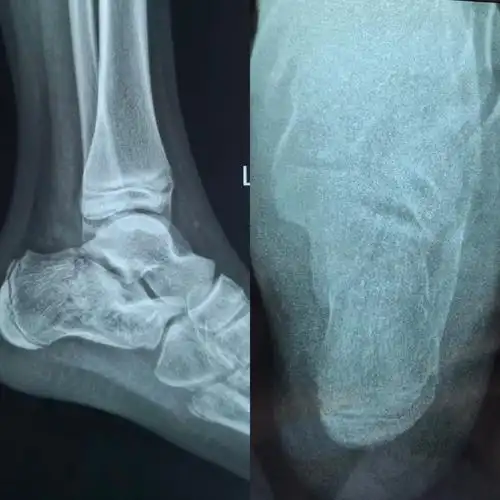 术前跟骨侧轴位片